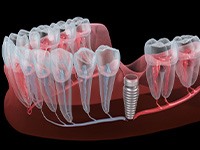 Illustration of single dental implant in gum tissue.