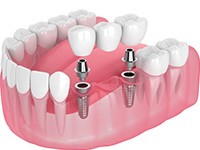 Exploded illustration of dental implants with bridge