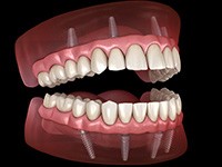 Illustration of implant dentures