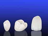 Three ceramic dental crowns on blue background