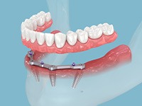 a 3D illustration of all-on-4 dentures